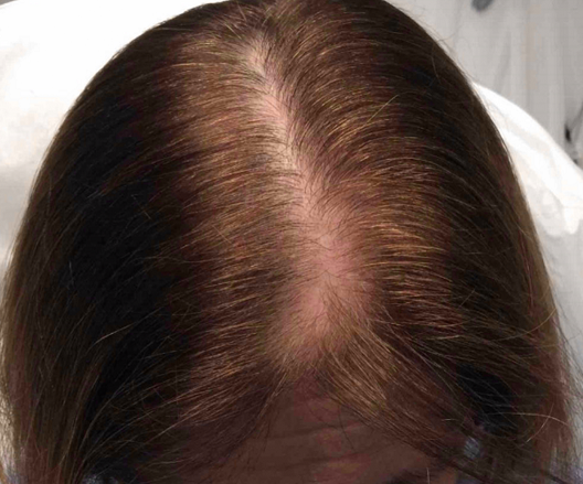 mezoterapia-iglowa-gdansk-przed-i-po